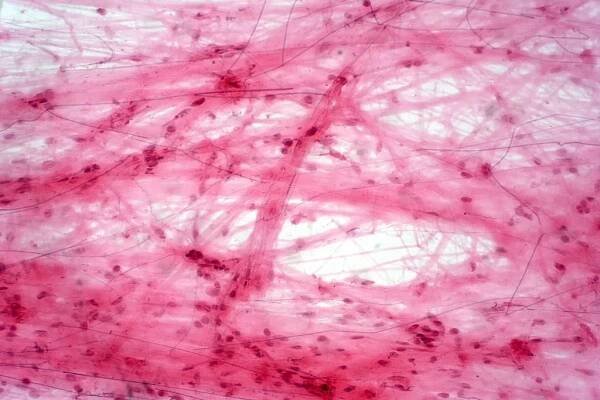Exploring Joint and Connective Tissue Disorders