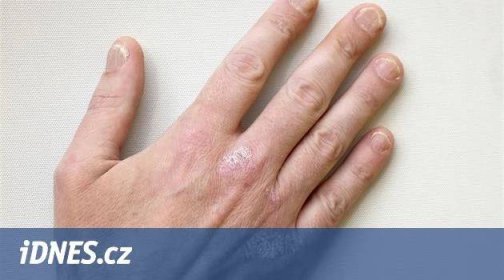Artritida, dřívější infarkt a deprese. Lupénka nepostihuje jen kůži - iDNES.cz