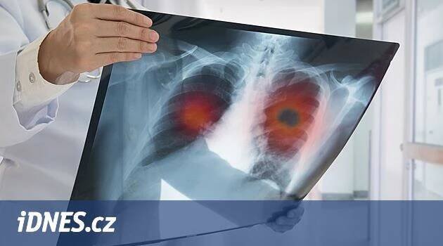 Bolela ji záda, lékaři ženě našli rakovinu plic. Každý rok zabije pět tisíc Čechů - iDNES.cz