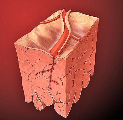 Ischemická choroba srdeční – WikiSkripta