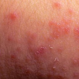Textury kůže příznaky ekzém Atopická dermatitida — Stock fotografie