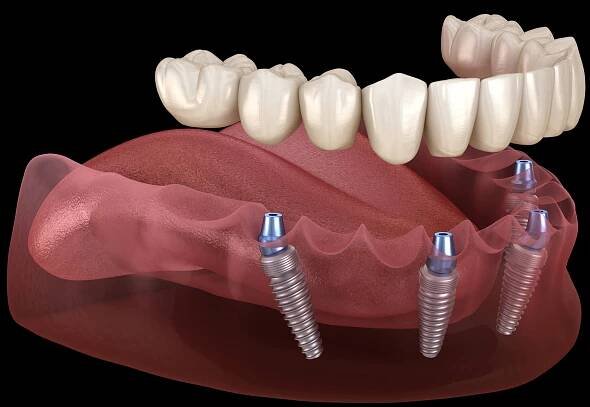 Mandibulární protéza Vše na 4 systému podporované implantáty. Lékařsky přesná 3D ilustrace konceptu lidských zubů a zubů — Stock obrázek