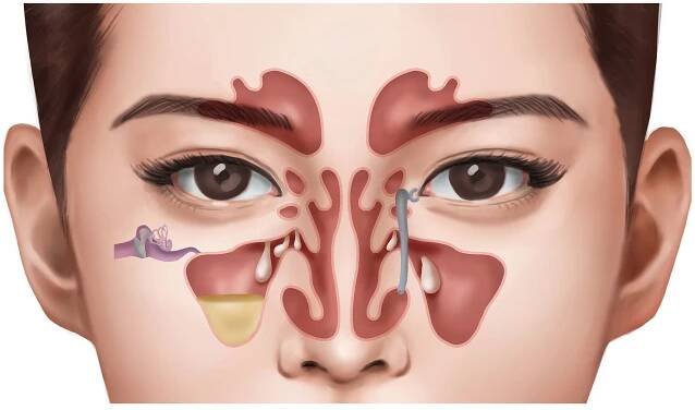 Polypy v nose - čínská medicína, přírodní léčba, bylinky