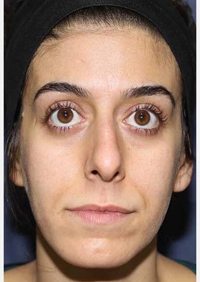 Fotoğraflar | Video Endoscopic Micro-Rhinoplasty