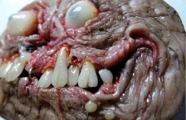 teratoma tumor / Facebook Pictures of History