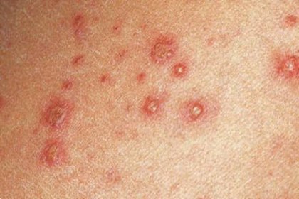Chickenpox: symptoms and treatment