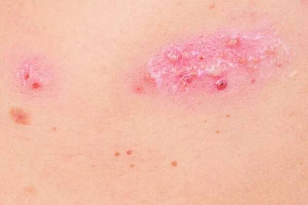 Kožní vyrážka léčba na těle ženy. pásový opar, choroba, herpes zoster, virus varicella-zoster. kožní vyrážka a puchýře na těle — Stock obrázek