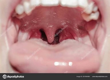 Stáhnout - Hrtan jazyk v krční uzliny virová zánět mandlí pro medicínu — Stock obrázek