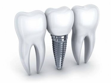 6 Fascinating Benefits of Dental Implants - Glenn LoSasso at Brevard Smiles