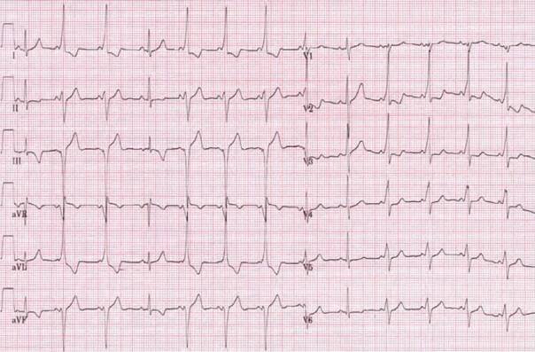 ECG intermittent WPW syndrome type B, sinus rhythm