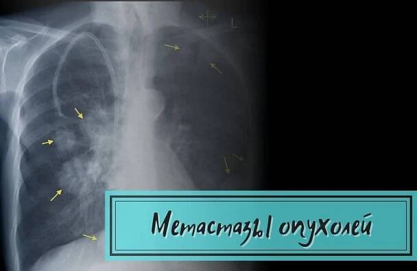 Метастазы опухоли