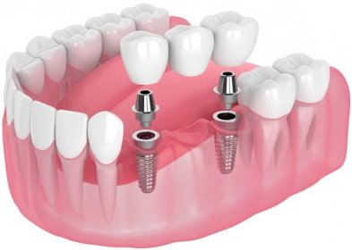 The Benefits of Dental Implants for Oral Health