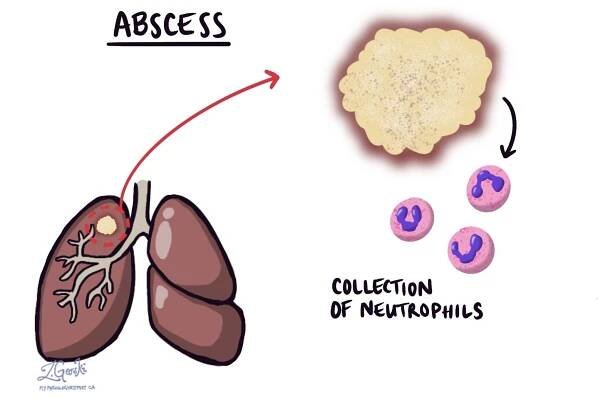 Co je to absces?
