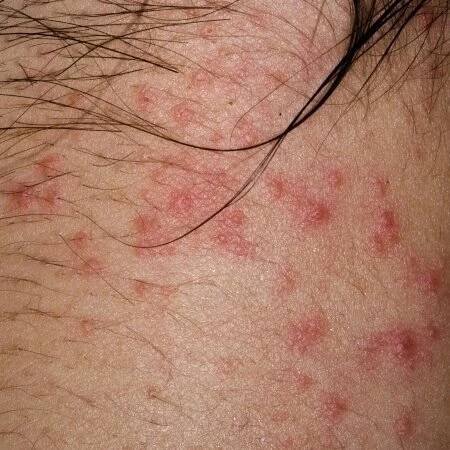Fotoalergická dermatitida: příčiny, příznaky, diagnostika a léčba