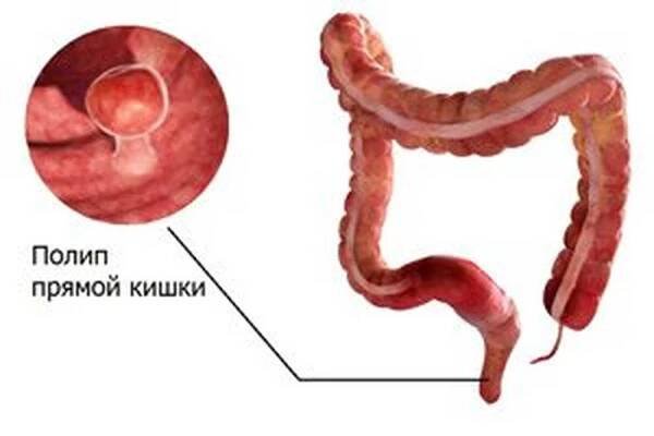 Příčiny, příznaky, léčba a odstranění polypů v konečníku / Polypy | Užitečné informace a tipy na péči o sebe. Zdraví, výživa
