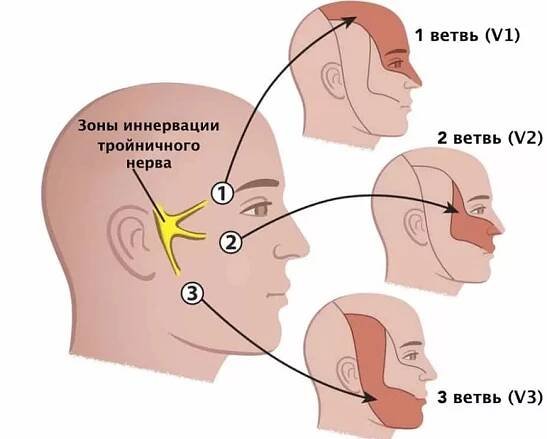Neuralgia of the trigeminal nerve 1