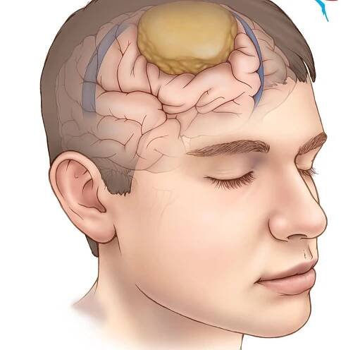 30-facts-about-meningioma-1