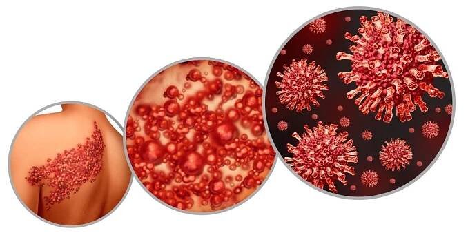 Herpes – co je to, typy, příznaky a jak se jej zbavit? - Rubrika.cz