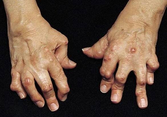 Boutonnière Deformity - Bone, Joint, and Muscle Disorders - MSD Manual Consumer Version