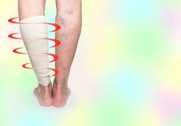 Nohy. Křečové žíly. Phlebeurysm. Tromboflebitida. Elastický obvaz — Stock obrázek