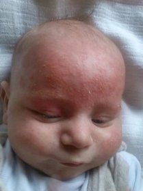 Běžná kožní onemocnění u novorozenců