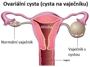 Ovariální cysta (cysta na vaječníku) - ilustrace