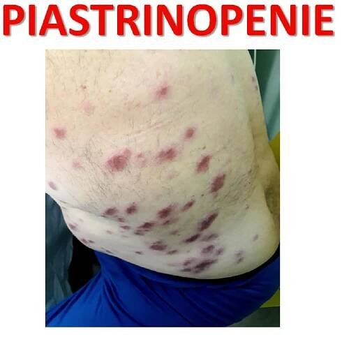 Piastrinopenia