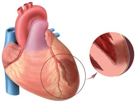 Infarkt