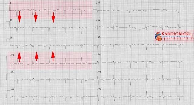 (ZAČÁTEČNÍCI) Prohozené svody na EKG - Kardioblog