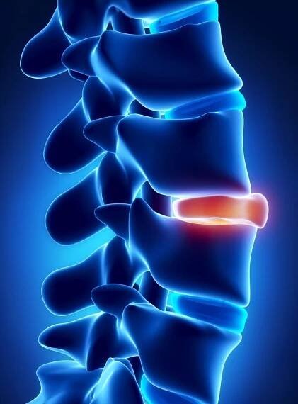 What Are Disc Herniations?