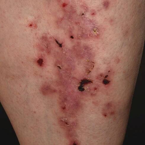 Lichen planus atrophicans