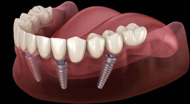 Mandibulární protéza Vše na 4 systému podporované implantáty. Lékařsky přesná 3D ilustrace konceptu lidských zubů a zubů — Stock obrázek