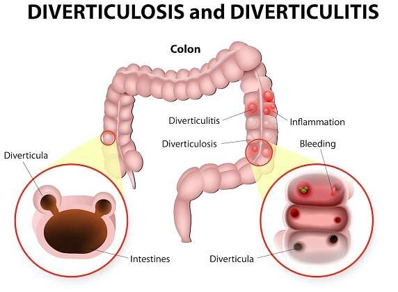 Diverticulosisanddiverticulitisdiverticulaarepocketsthatdevelopinthe   Daily Catchers
