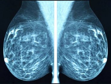 Interpreting The Mammography Report - RadComm
