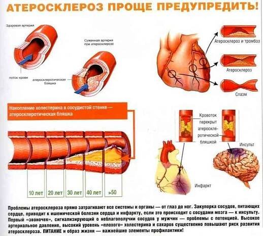 Příznaky aterosklerózy, diagnóza, léčba / Cévní nemoci | Užitečné informace a tipy na péči o sebe. Zdraví, výživa a další