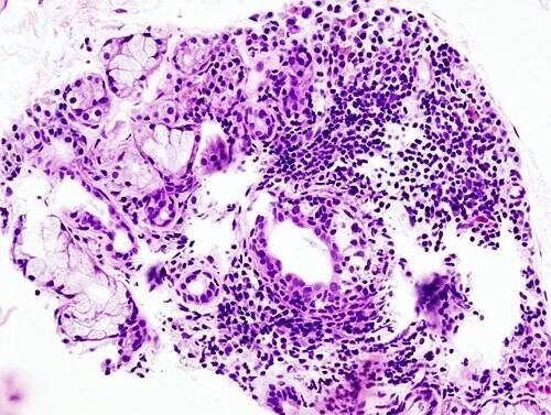 Histopatologický obraz infiltrace malých slinných žláz lymfocyty (plazmatickými buňkami) – biopsie slinných žláz