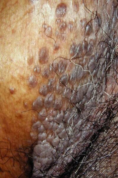 Genital warts on the perineum caused by human papillomavirus (HPV)
