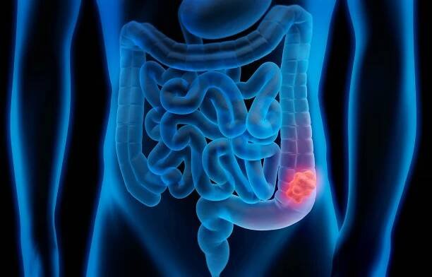 Medical illustration of colorectal cancer.