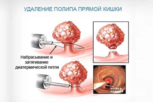 Лечение колита в Ростове по выгодной цене - Doctor-Prof