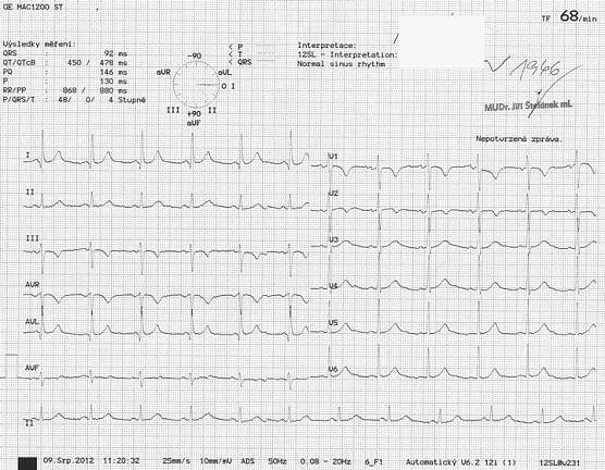 EKG z praxe 20 | Medicína, nemoci, studium na 1. LF UK