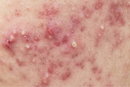 Akné na kůži obličeje, dermatologické onemocnění akné — Stock obrázek