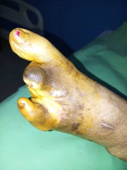 Mrs Raji Ramanathan - Diabetic foot Dry gangrene Amputated - Welcome to Dr. Amina's Royal Ayurveda™