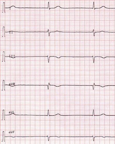 ECG muddle junctional av bradycardia, 33 bpm