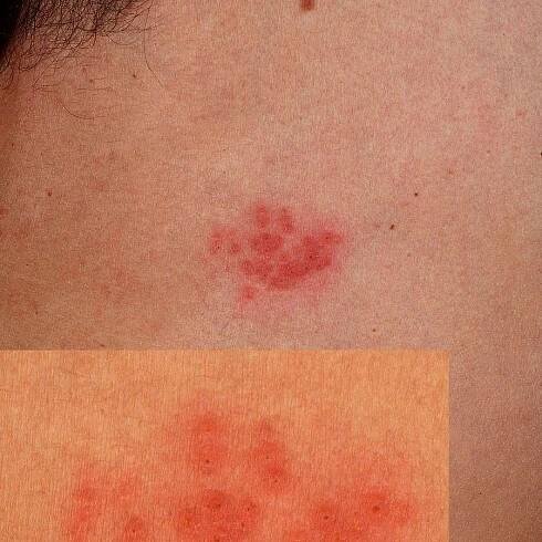 Herpes simplex recidivans