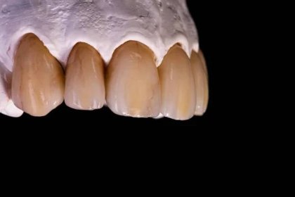 Zubní korunky. Detail keramické zubní korunky — Stock obrázek
