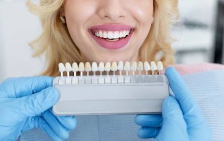 Zirkoniové fazety Cena UK 2023 – Výhody zirkoniových zubních fazet 3
