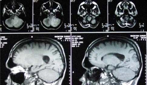 Olomoučtí vědci odhalili, jak se agresivní nádor mozku brání léčbě