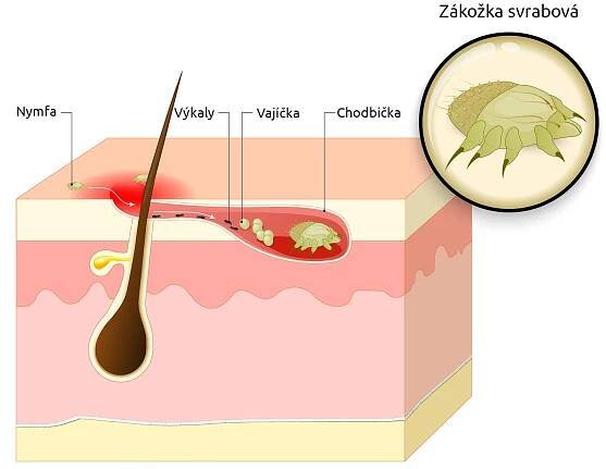 zákožka – původce svrabu