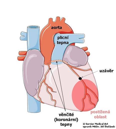 Infarkt myokardu (srdeční svaloviny) | Medicína, nemoci, studium na 1. LF UK