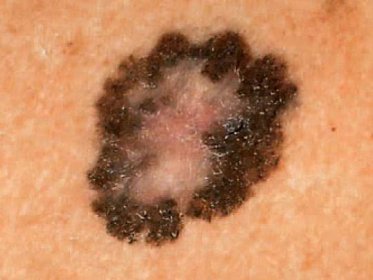 Jak se projevuje rakovina kůže